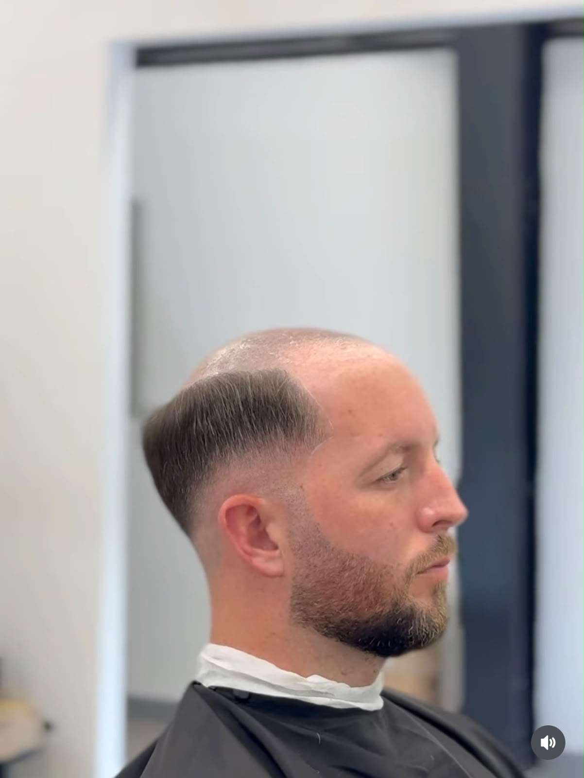 Hair Repair Club Dubai client before hair system, thinning on top